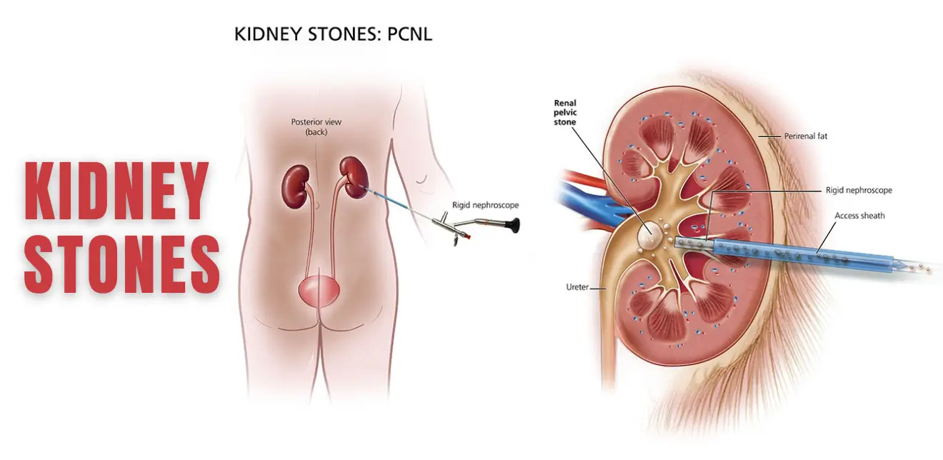 Kidney Stones