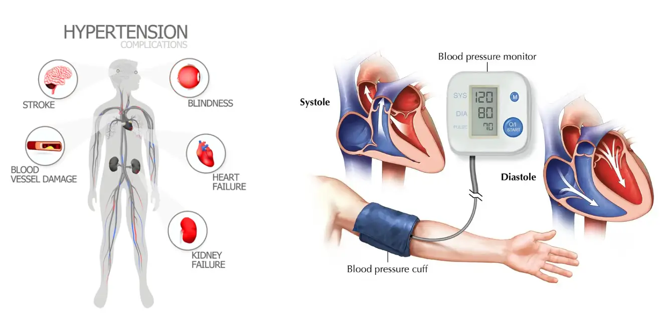 hypertension and blood pressure disorders